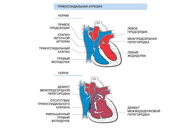 Недостаточность трехстворчатого клапана рисунок